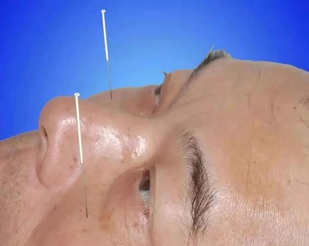 美尼尔综合症针灸疗法