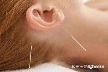 美尼尔综合症针灸疗法