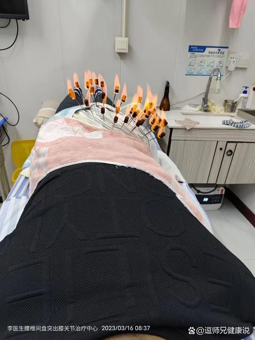 针灸治疗腰椎骨质增生