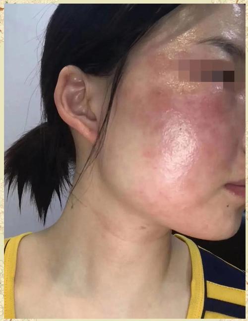 激素依赖性皮炎脸针灸