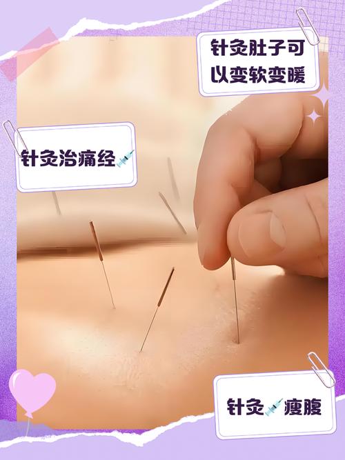 肚子上针灸治疗什么的