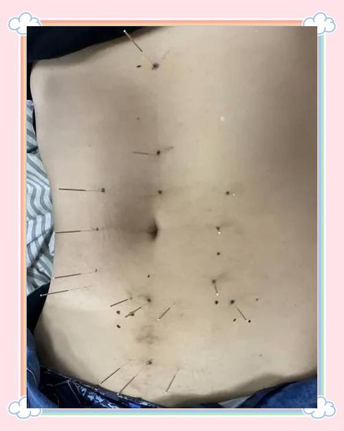 肚子上针灸治疗什么的