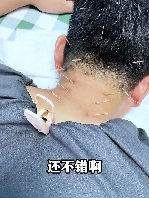 颈椎病针灸几次有效果