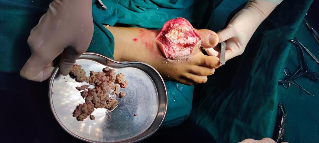 外科手术会引发的痛风