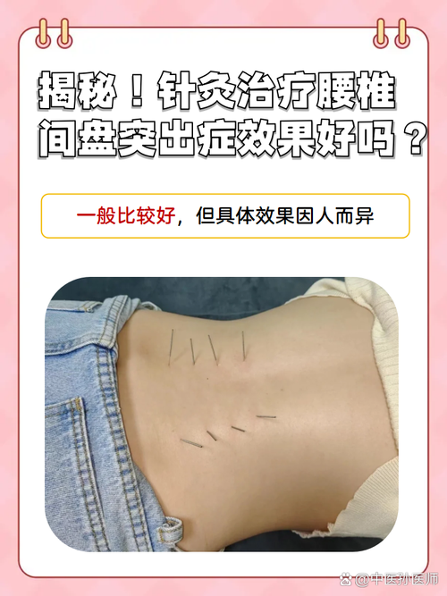 腰椎可以用针灸治疗吗