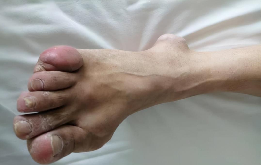 北京东直门中医院痛风