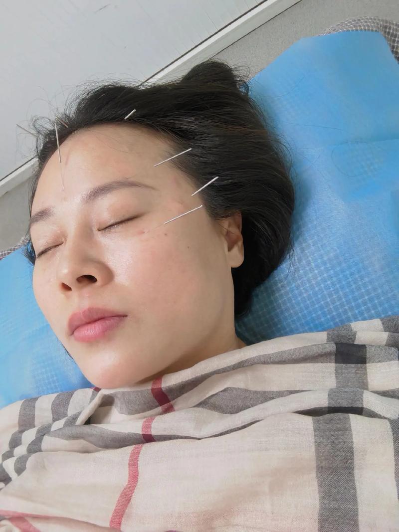 视神经受损水肿用针灸