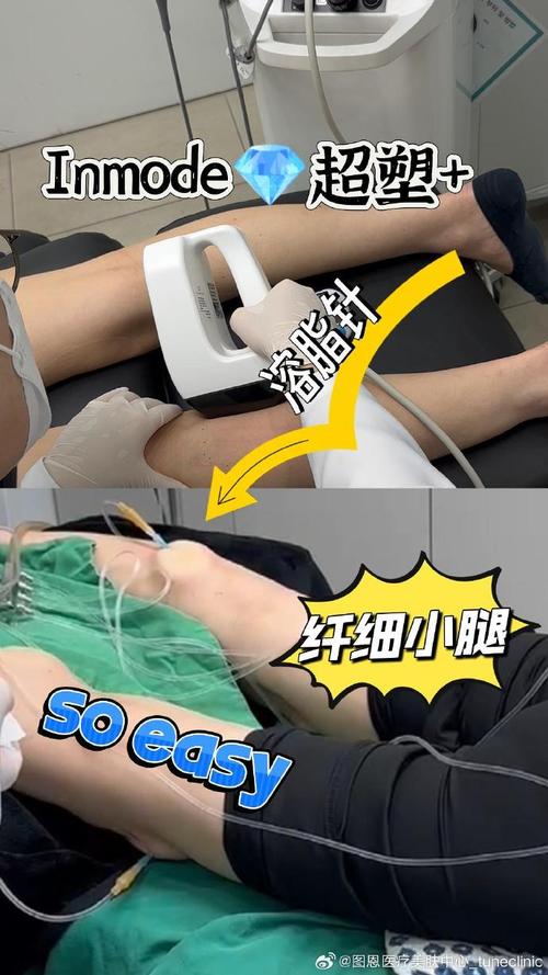 botox瘦腿针安全么