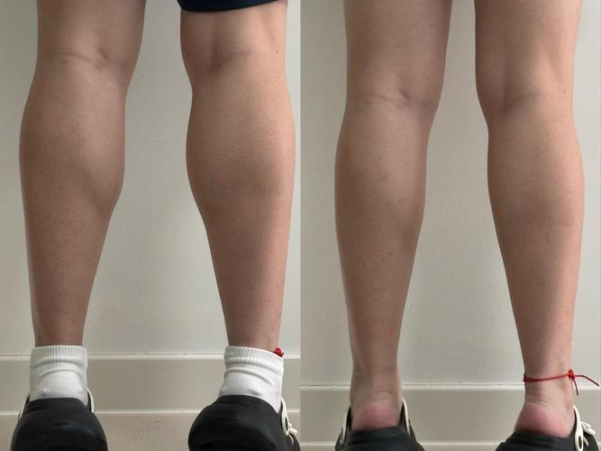 botox瘦腿针安全么