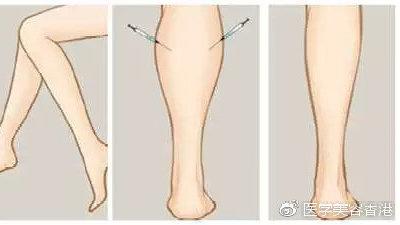 botox瘦腿针安全么
