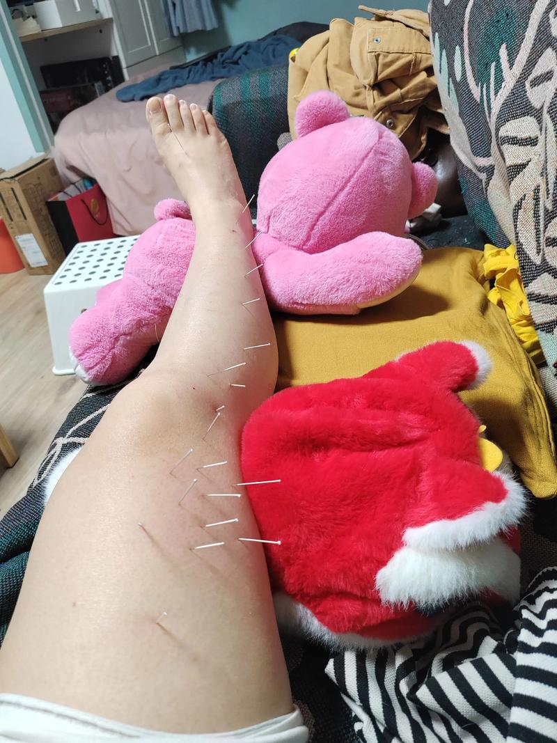 小腿针灸后的最佳反应