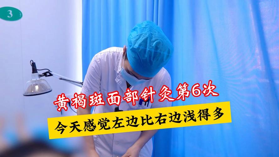 曲靖哪里可以针灸祛斑