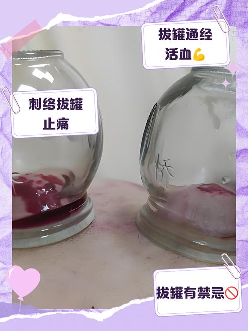 针灸之后可以拔火罐吗