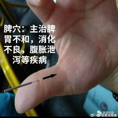 胃病针灸需要每天做吗