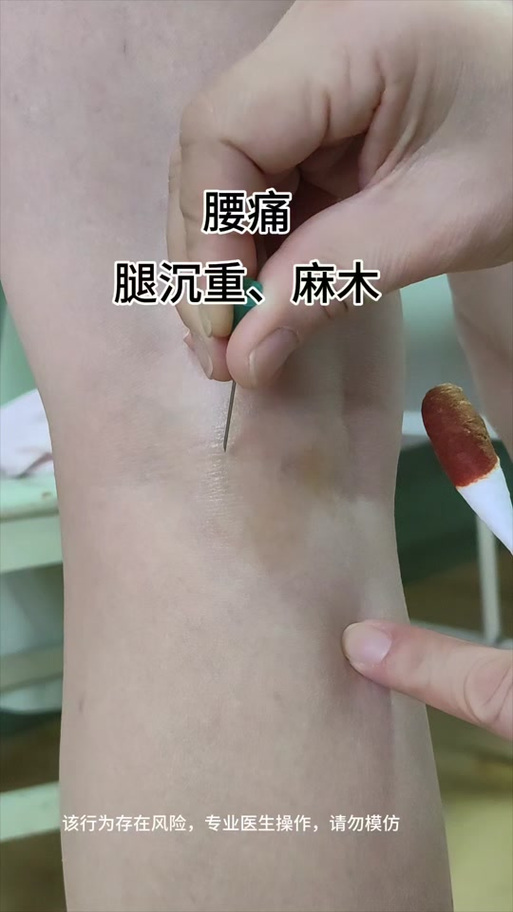 腿部有血栓可以针灸吗