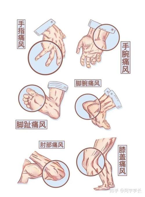 痛风老是不消肿怎么办