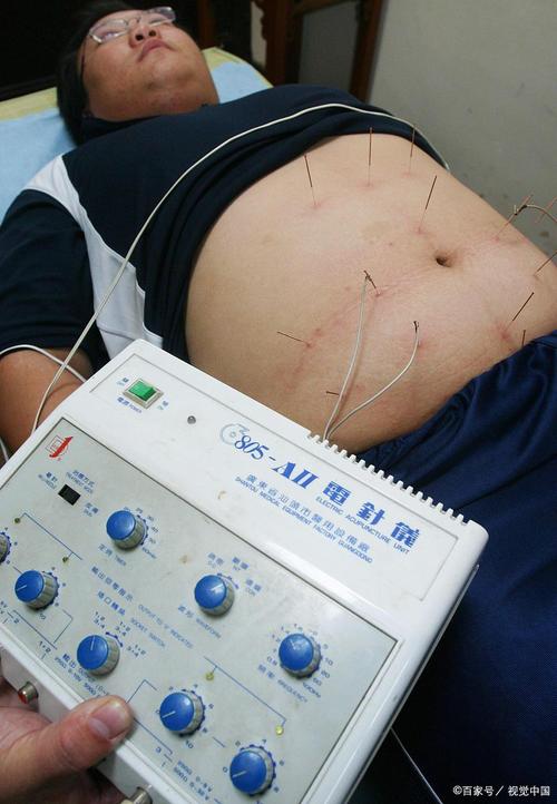 子宫肌瘤能针灸减肥吗