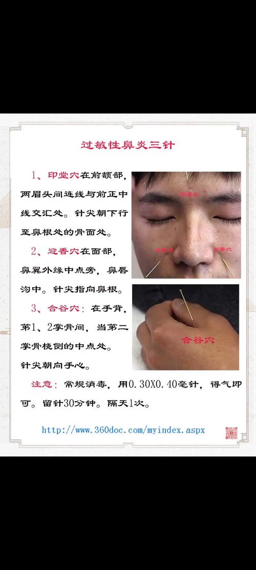 针灸治疗鼻炎有效果吗