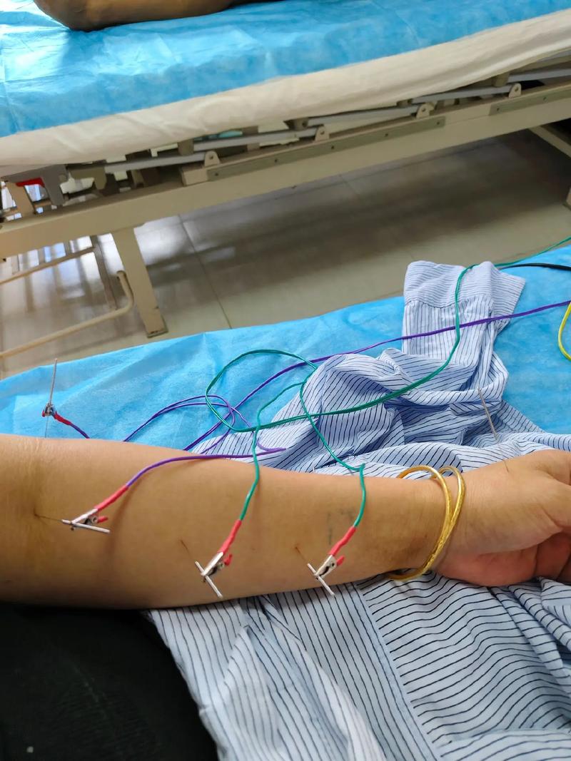 试管移植前内膜薄针灸