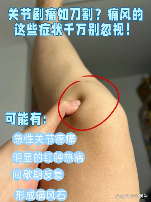 痛风膝盖肿是怎么回事