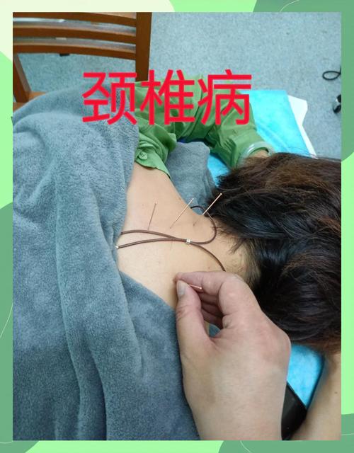 颈椎针灸后可以喝酒吗