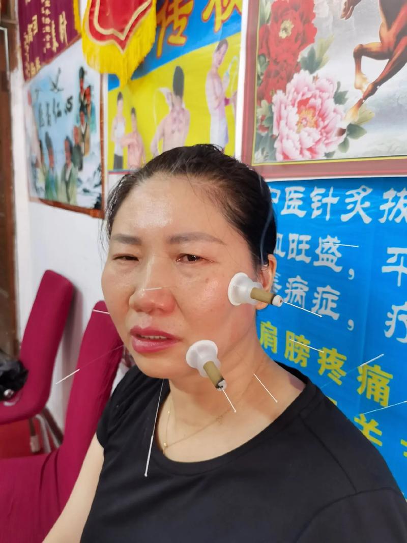 面瘫什么时候针灸最好