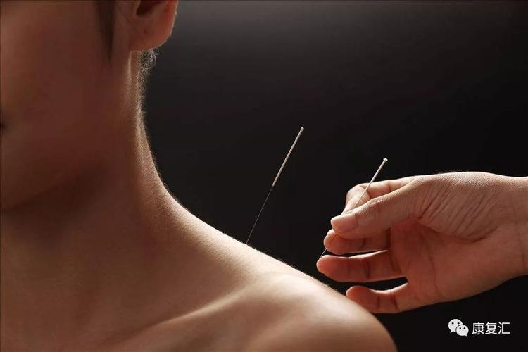 帕金森综合症针灸治疗