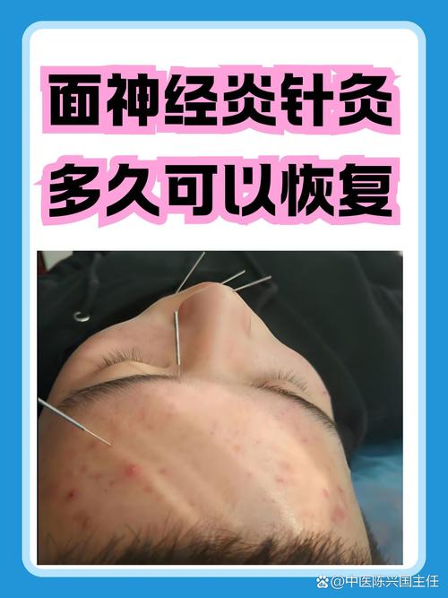 面瘫针灸之后能热敷吗