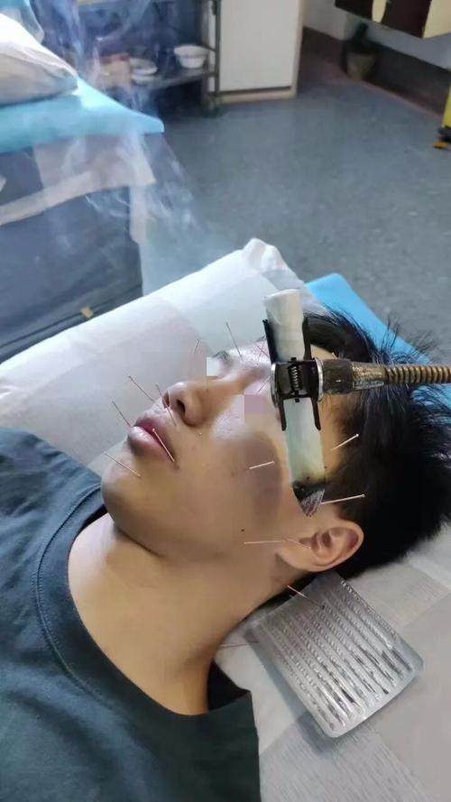 面瘫针灸后的最佳反应