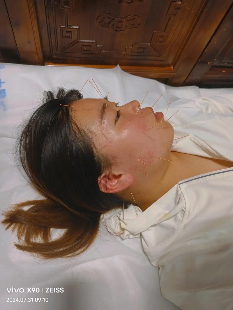 面瘫针灸后的最佳反应