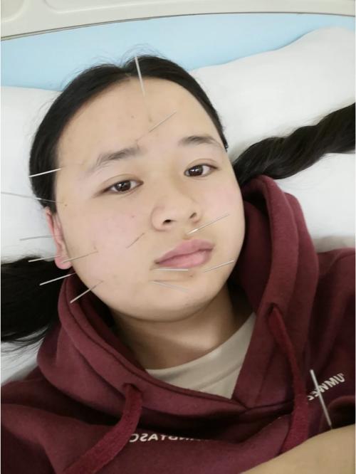 面瘫针灸后的最佳反应