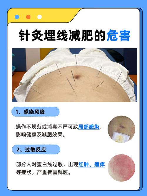 沈阳四院针灸减肥好吗