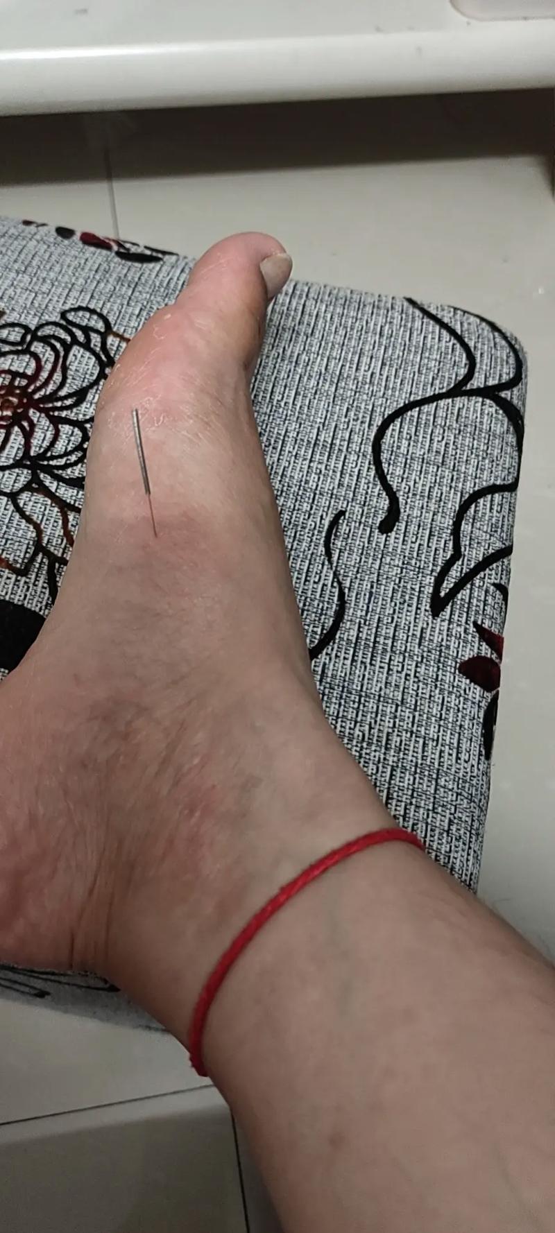 针灸能治疗乳腺结节吗