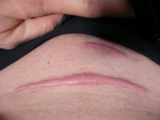 剖腹产疤痕厚度多少安全