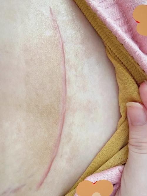 剖腹产疤痕厚度多少安全