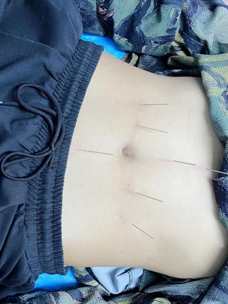 针灸调理脾胃后的反应