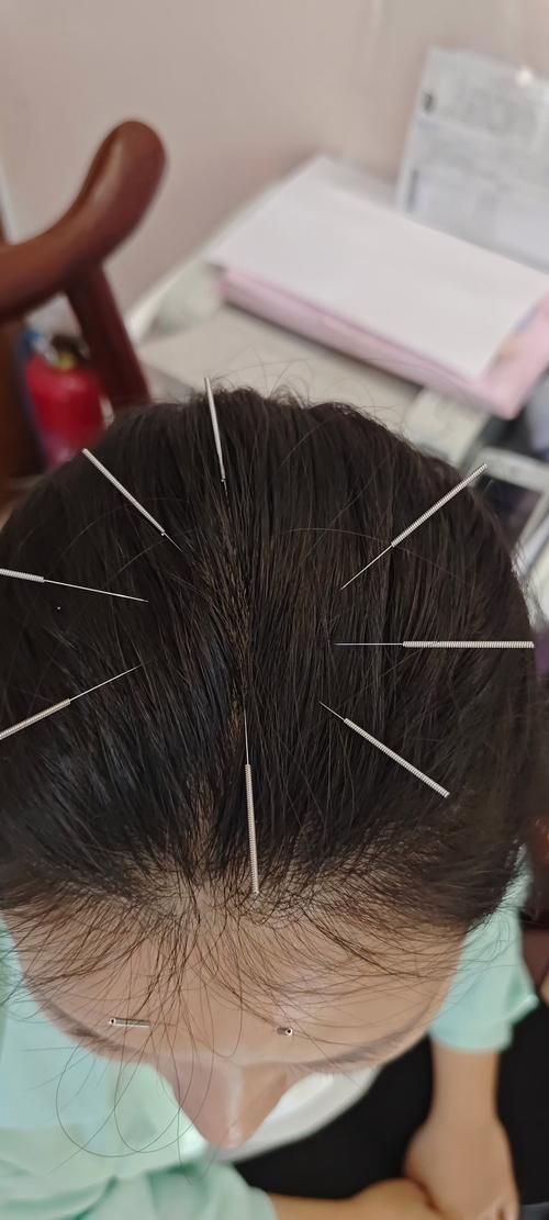 针灸治疗头疼效果如何
