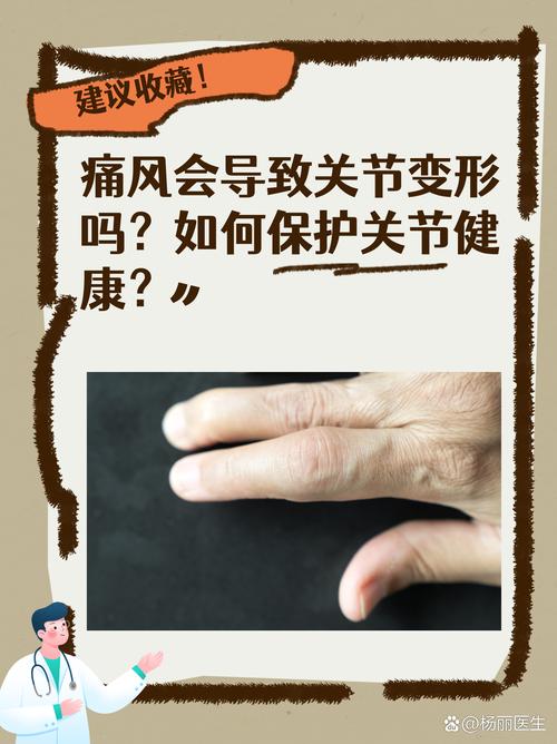 痛风关节变形如何治疗