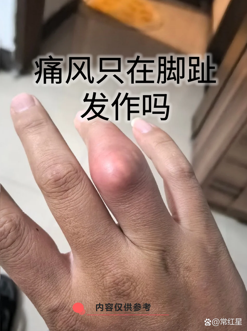 大脚趾痛风初期很疼么