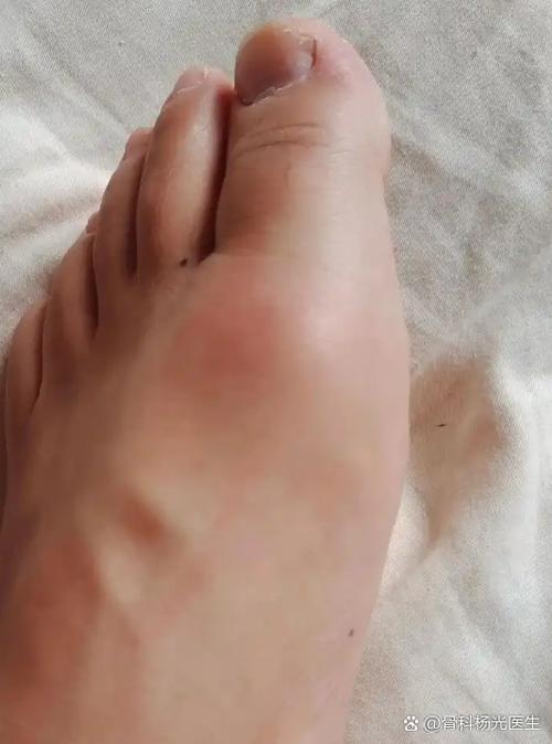 大脚趾痛风初期很疼么