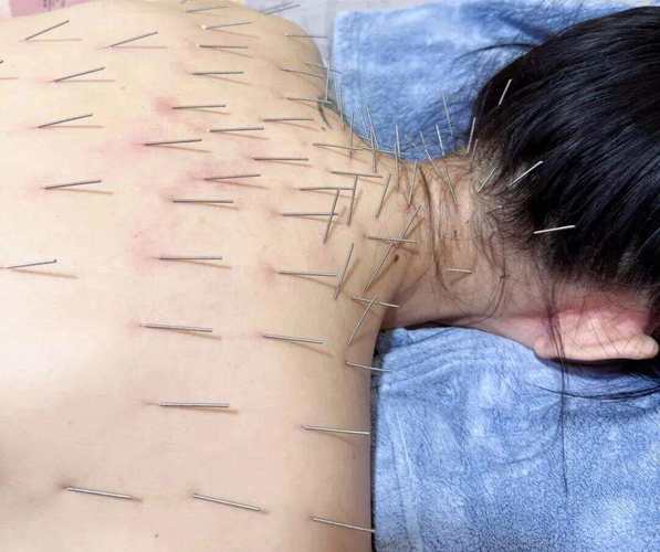 针灸能修复面部色素吗
