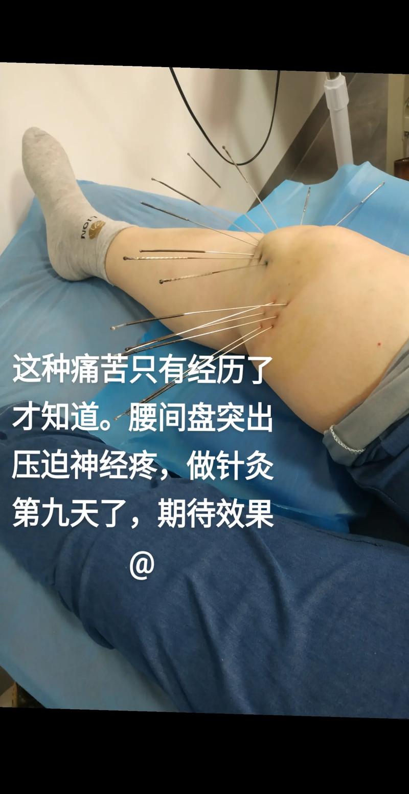 针灸能缓解腰椎劳损吗