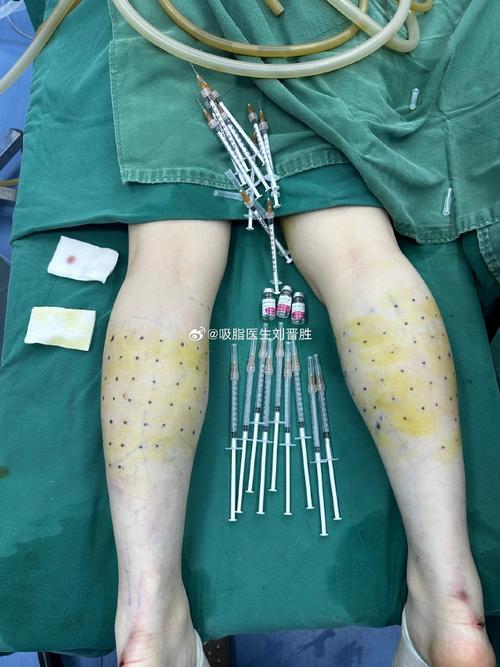 注射botox瘦腿安全