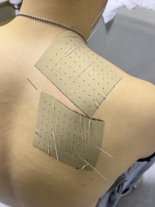 臂丛神经损伤针灸治疗