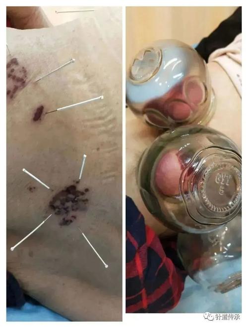 针灸治疗带状疱疹视频