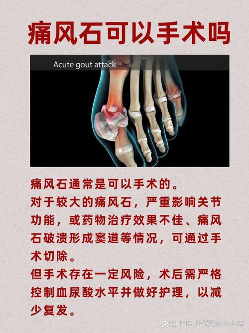 痛风关节结晶怎么治疗