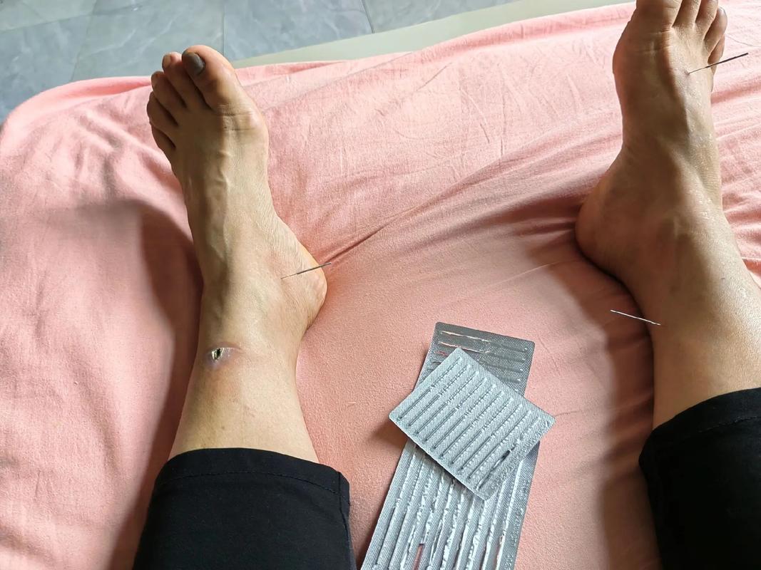 脚后跟疼中医针灸治疗