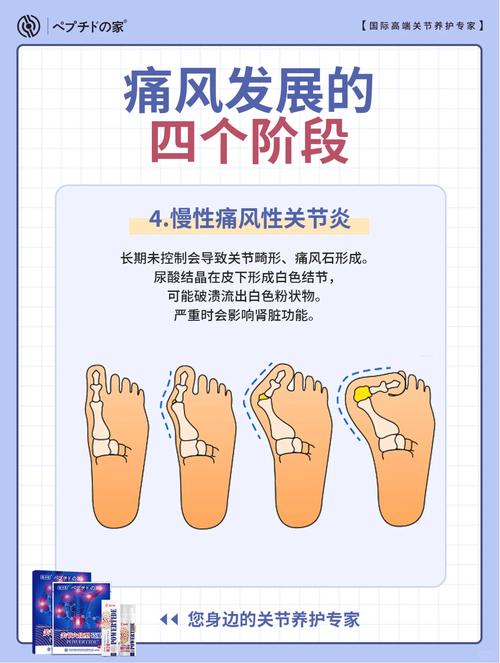 风湿痛风的症状有哪些