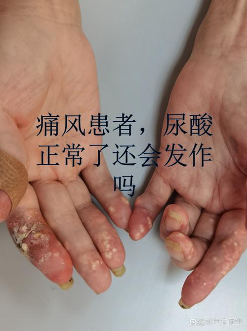 男朋友有痛风还能嫁吗