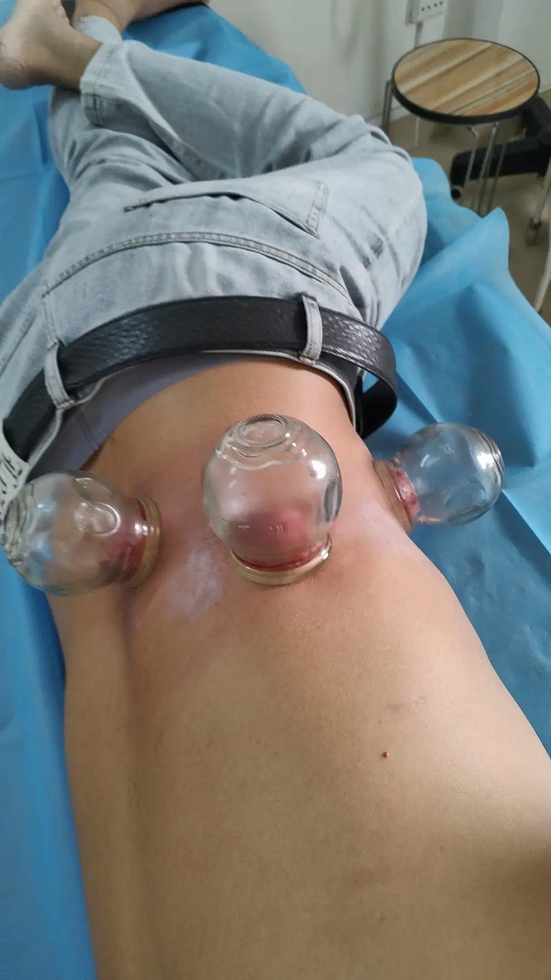 带状疱疹能用针灸治疗